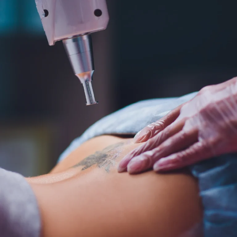 tratamiento-eliminacion-tatuajes-cemetri